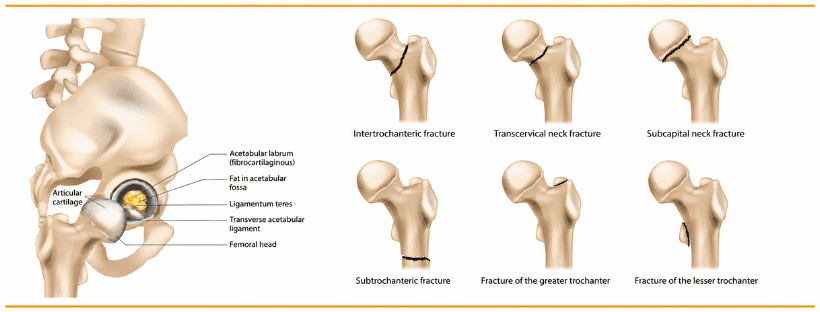 Who Need Hip Replacement Surgery