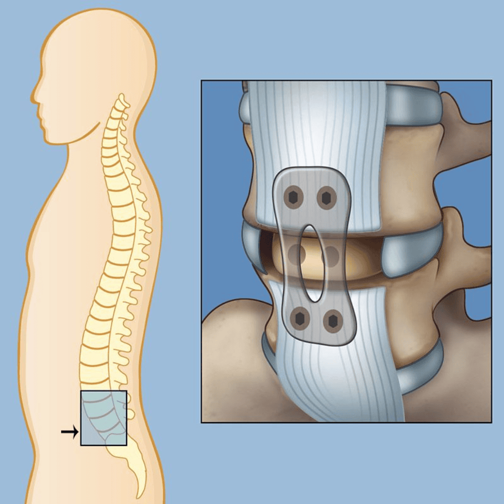 ALIF Surgery