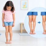 How to Fix Knock Knees in Children