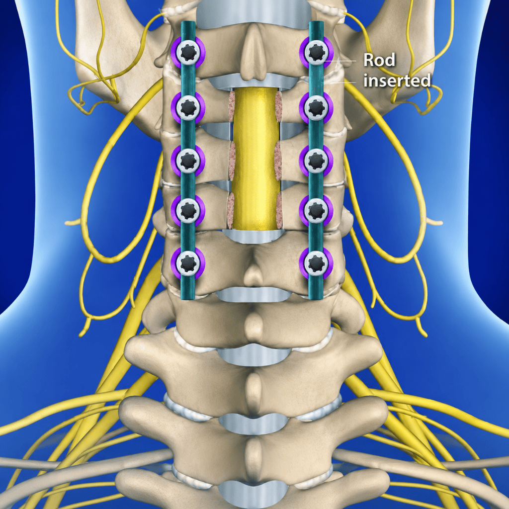 Laminectomy Surgery