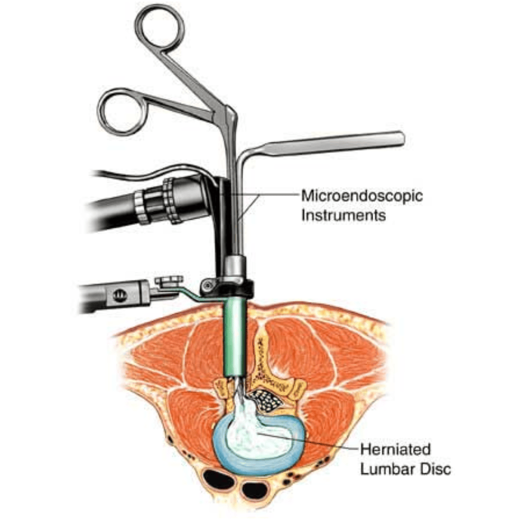 Minimally Invasive Spine Surgery