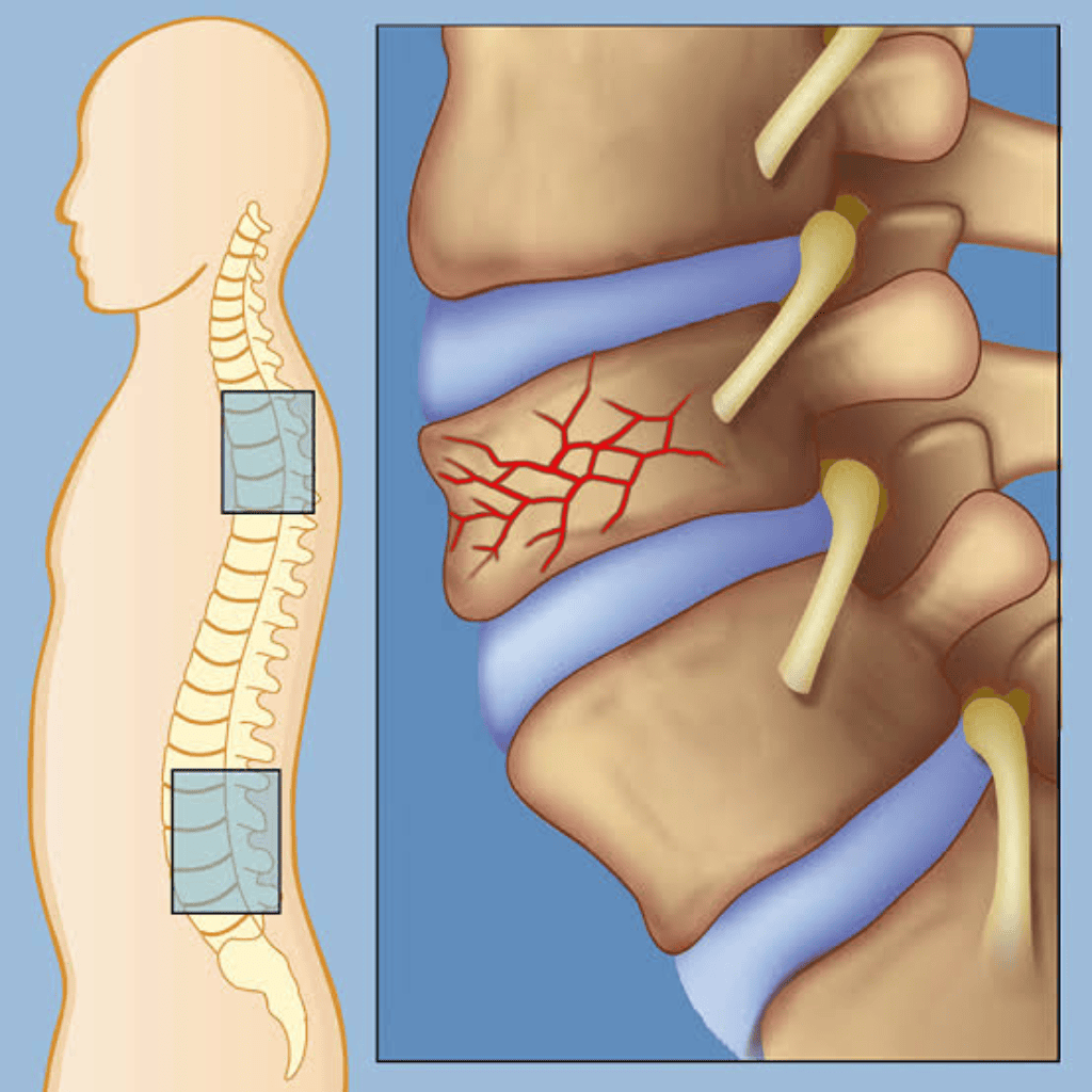 Spinal Fracture Surgery