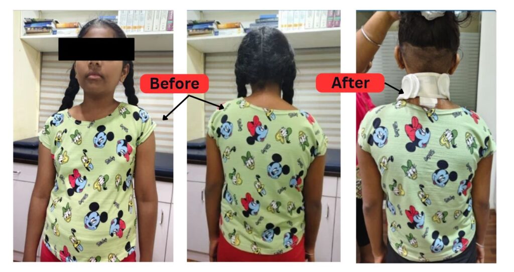 Before After Neck Shoulder Asymmetry
