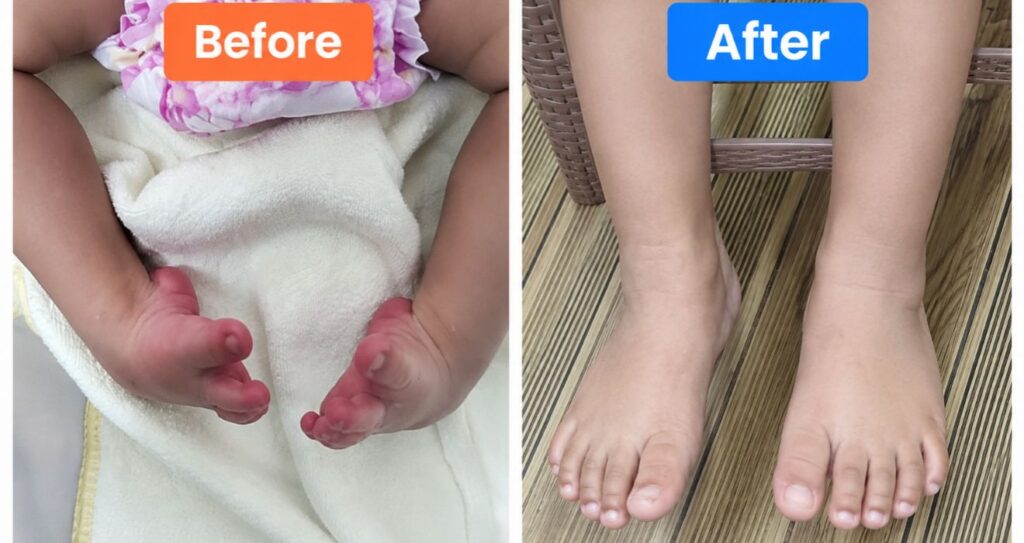 Clubfoot Treatment Without Surgery