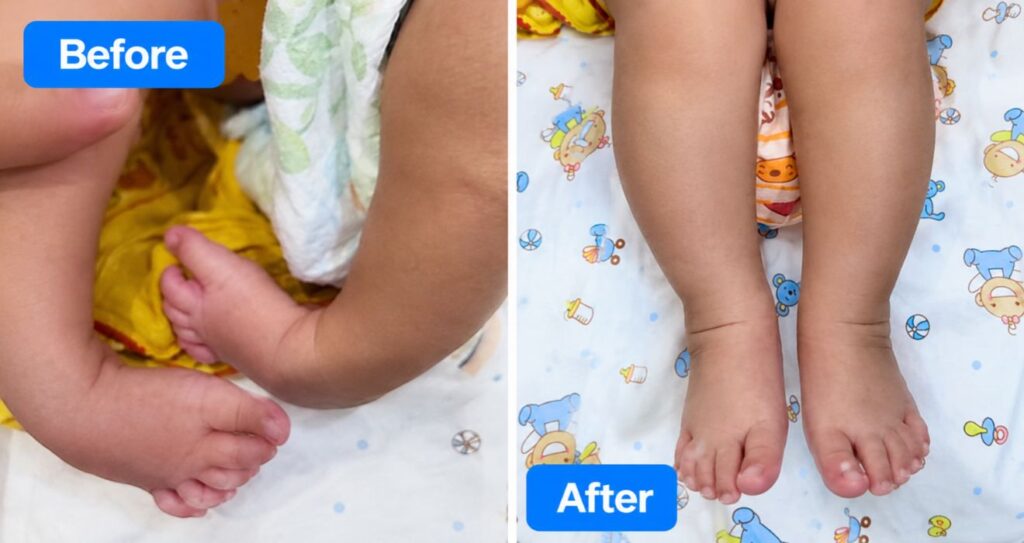 Clubfoot Treatment Without Surgery