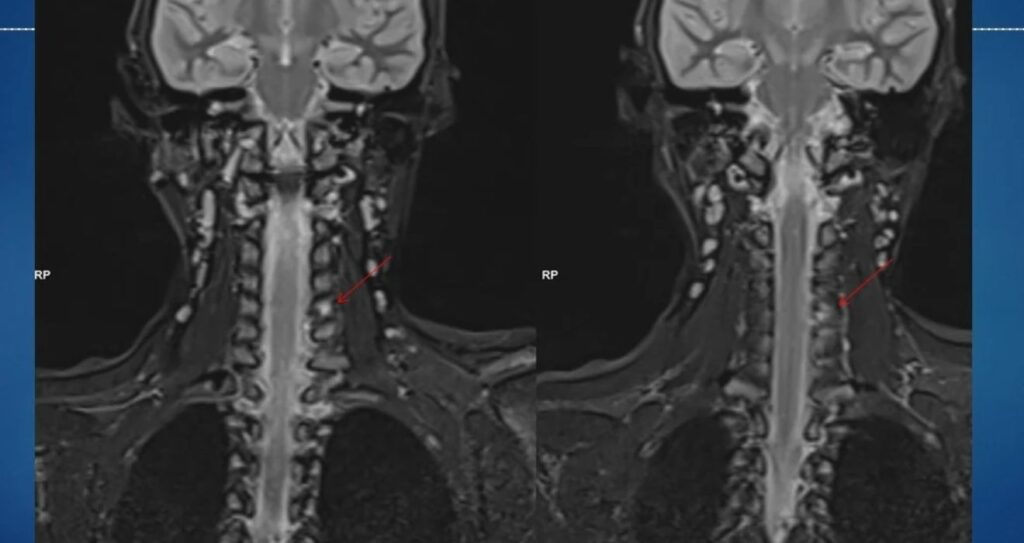 spine tumour in a child